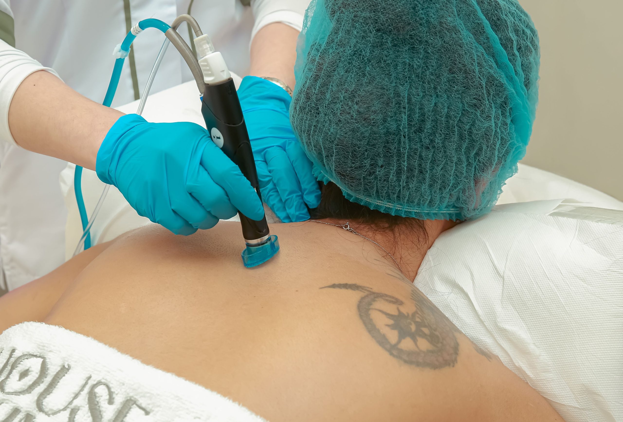 Tattoo Removal in Ahmedabad